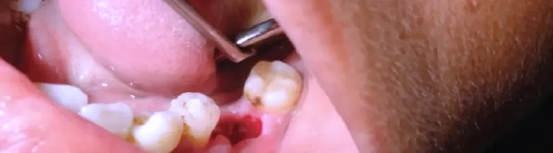 Dry Socket