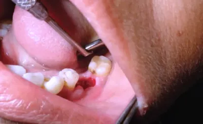 Dry Socket